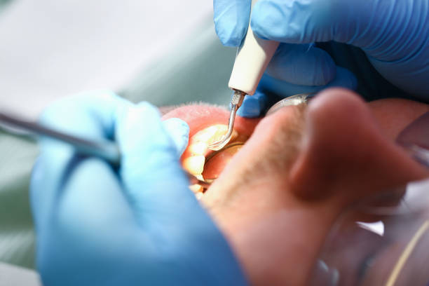 Best Emergency Tooth Extraction in Mchenry, IL